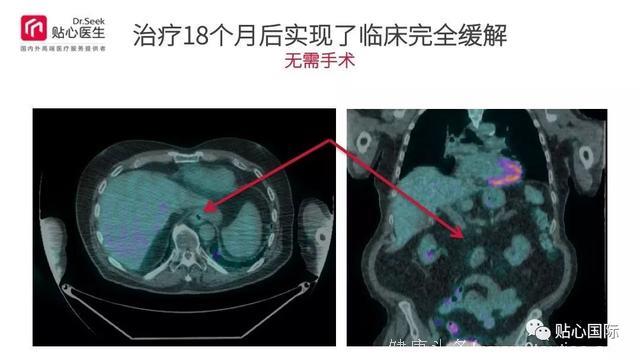 质子治疗—最好的癌症治疗权威案例