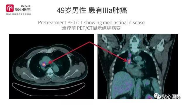 质子治疗—最好的癌症治疗权威案例