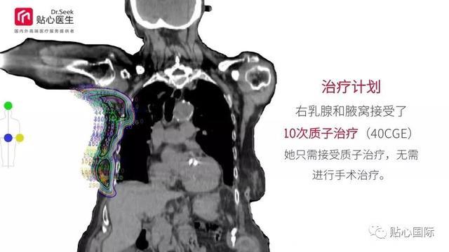 质子治疗—最好的癌症治疗权威案例