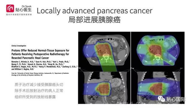 质子治疗—最好的癌症治疗权威案例