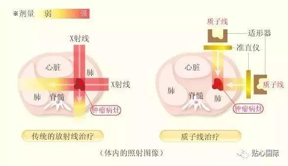 质子治疗—最好的癌症治疗权威案例