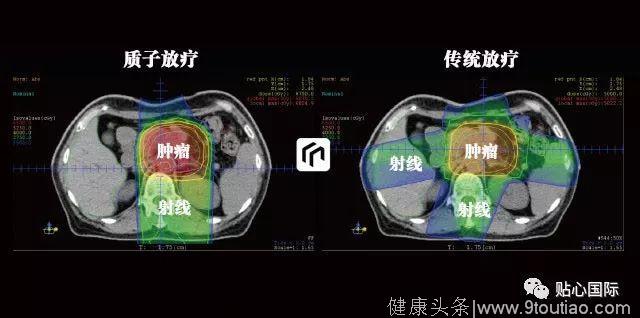 质子治疗—最好的癌症治疗权威案例