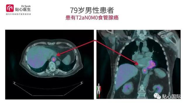 质子治疗—最好的癌症治疗权威案例