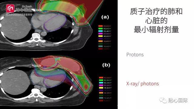 质子治疗—最好的癌症治疗权威案例