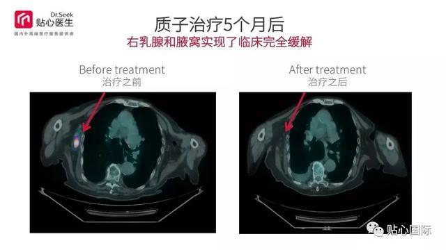 质子治疗—最好的癌症治疗权威案例