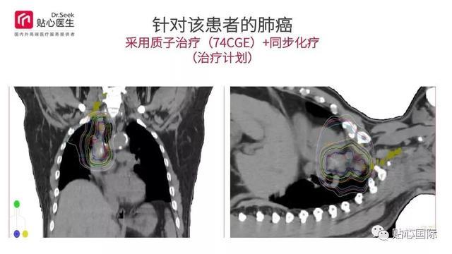 质子治疗—最好的癌症治疗权威案例