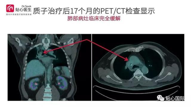 质子治疗—最好的癌症治疗权威案例