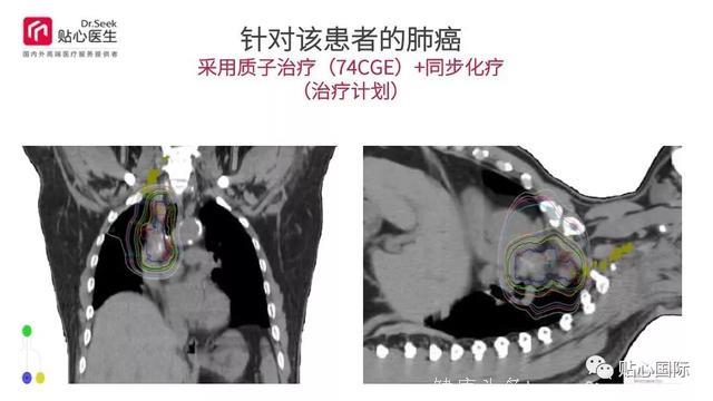 质子治疗—最好的癌症治疗权威案例