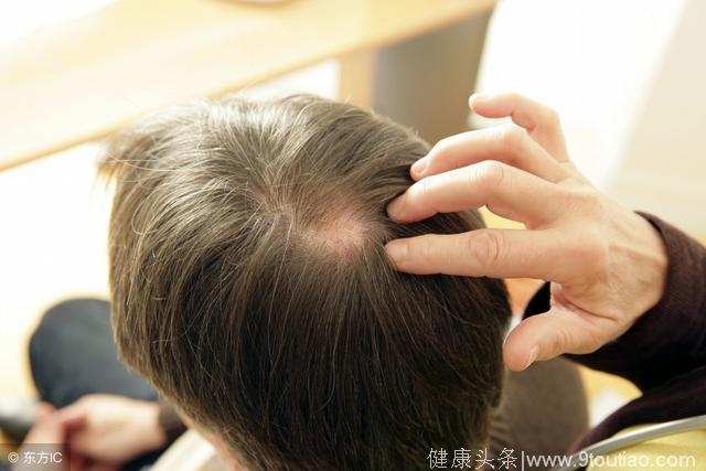 90后已经遭遇“脱发”危机？看看从医学上如何改善掉头发！