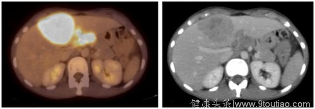 案例分享：对化疗免疫治疗完全应答的晚期结直肠癌案例