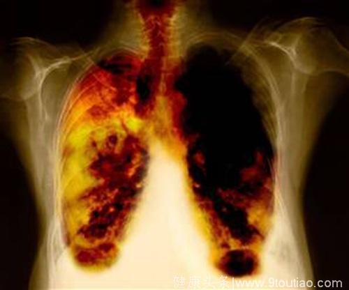 咳嗽反反复复老不好，可能是这5种肺病的征兆，最严重的是肺癌！