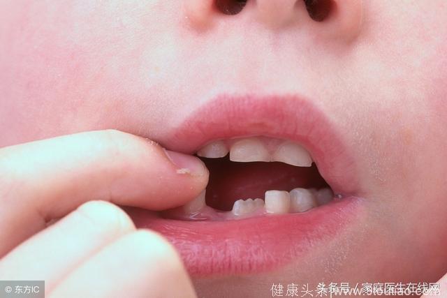 孩子牙齿会发黑是龋齿吗？龋齿会传染吗？听听医生怎么说