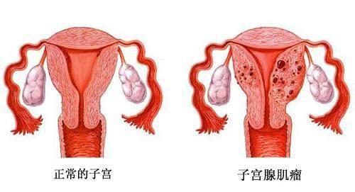 什么是子宫腺肌症呢？如果女性出现痛经等症状时，就要当心了