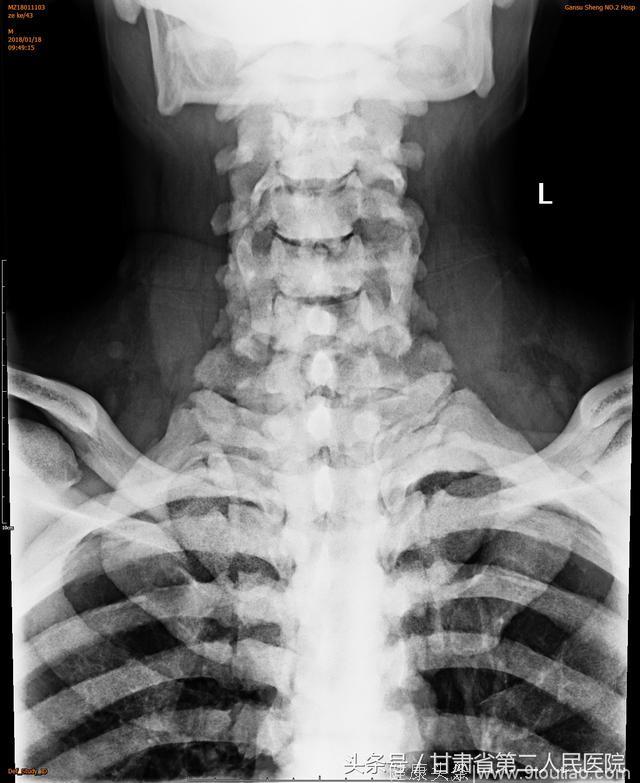 严重颈椎病折磨患者多年   省二院骨科团队手术除烦恼