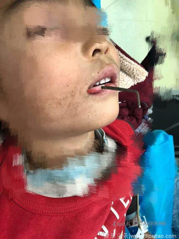 五岁男童被毛衣针刺穿口腔 医生巧用高清内镜将凶器拔出