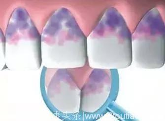 牙齿牙龈都没有伤口，为什么口腔会经常有血？