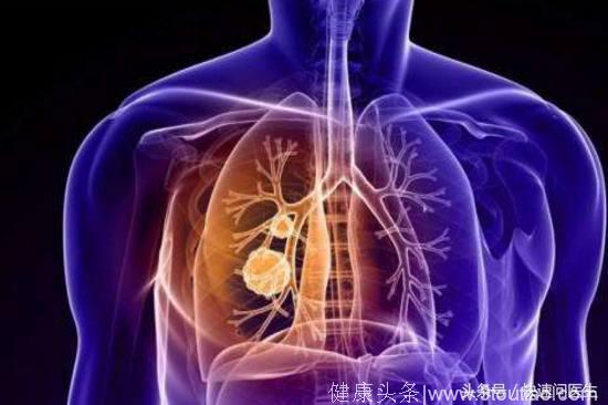 肺癌晚期食谱：肺癌晚期这么吃，既有营养调体质还能提高生命质量
