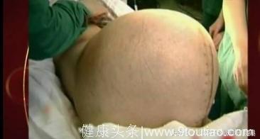 24岁孕妈喜获5胞胎，看到5个宝宝的性别后，产科医生都乐开了花
