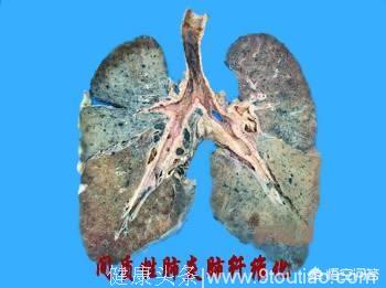 肺癌，肺气肿肺大泡患者的肺是什么样的，都和吸烟者的肺差不多