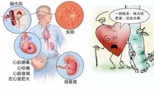 心血管疾病死亡威胁比癌症更可怕