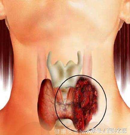 日核事故患癌复发？出现什么症状提示甲状腺复发了？