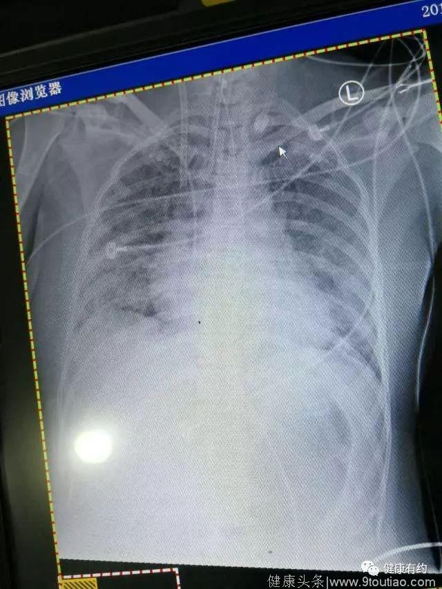 广州女子感冒6天后竟进了ICU！花了几十万，数闯鬼门关，过程超级凶险！