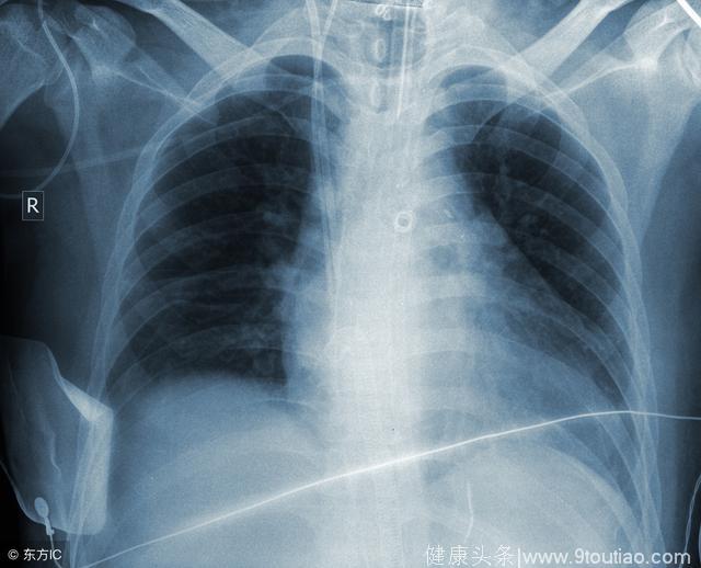 75%肺癌患者发现已是晚期！肺癌早发现真的那么难吗