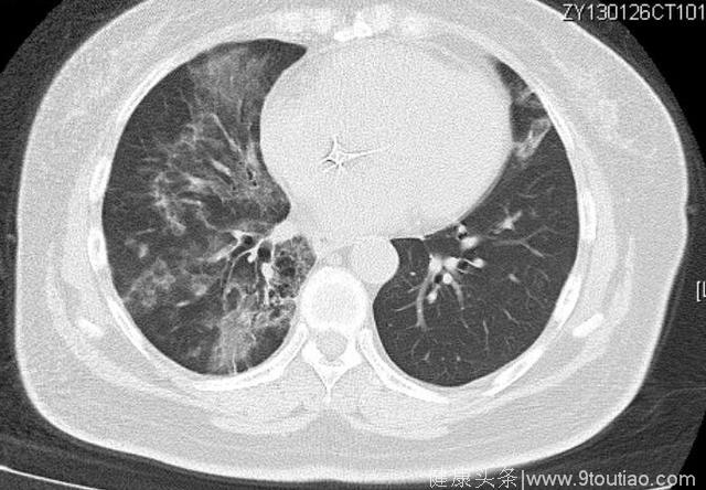 晚期肺癌已经生存5年——抗癌斗士案例