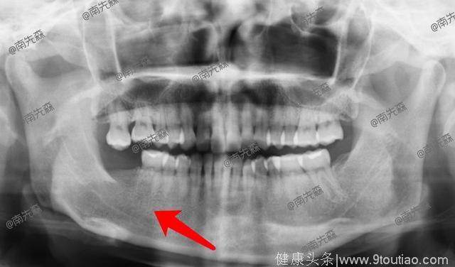 因为智齿，25岁的我差点被切掉半个下巴