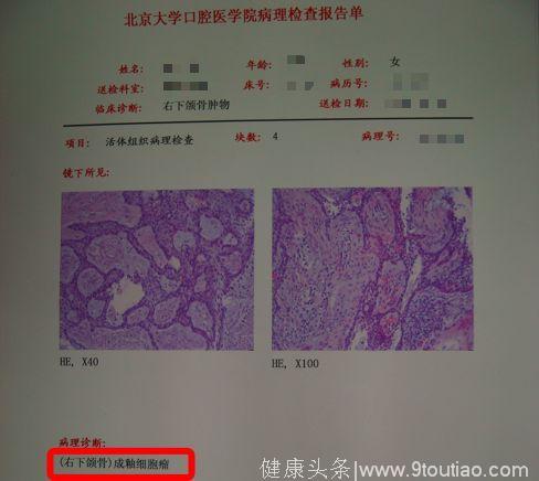 因为智齿，25岁的我差点被切掉半个下巴