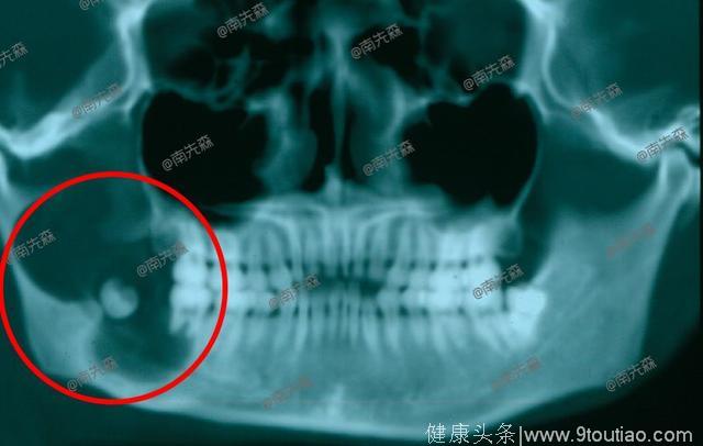 因为智齿，25岁的我差点被切掉半个下巴