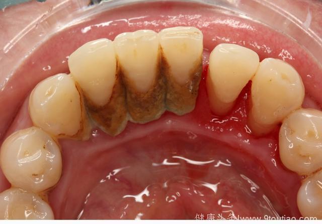 口腔医生揭秘：牙斑菌的三大危害，用这类牙膏可清除干净!