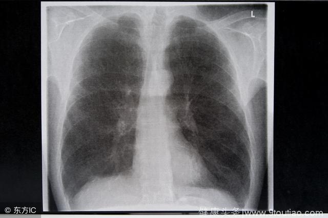 哪些症状出现表明肺癌已经发展为中后期呢