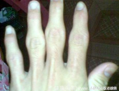 手指掰得“咔咔”响会得关节炎虽是错误观点，但确是会患这个病！
