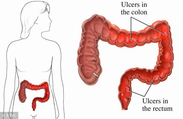 3个症状一错过，直肠癌说来就来，等到晚期就太迟了