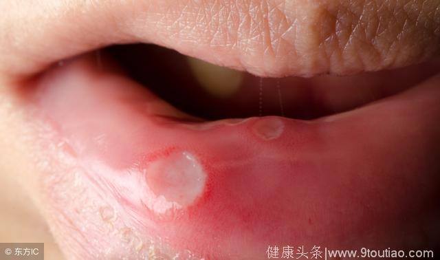 口腔溃疡是如何导致的？