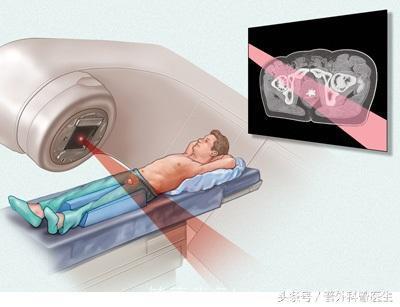 为什么诊断了直肠癌，医生让先去放疗，而不是马上做手术