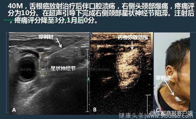 什么招？成都医生用“催眠神经”疗法 为癌症患者缓解疼痛