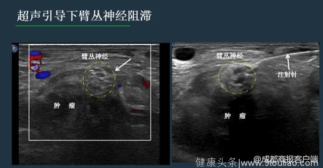 什么招？成都医生用“催眠神经”疗法 为癌症患者缓解疼痛