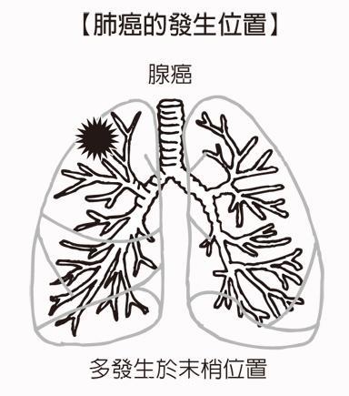 肺腺癌是肺癌吗？平时应该注意些什么，怎么预防？