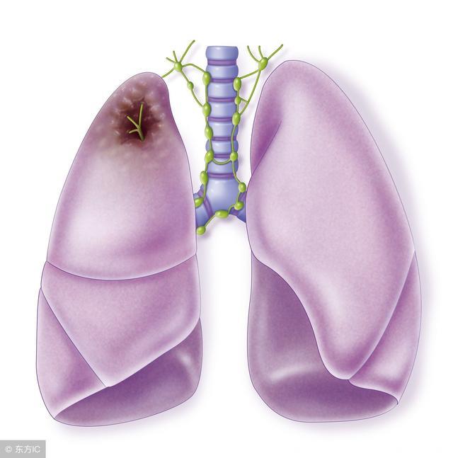 肺癌早期可同时出现多个临床症状，背部疼痛是肺癌早期信号吗