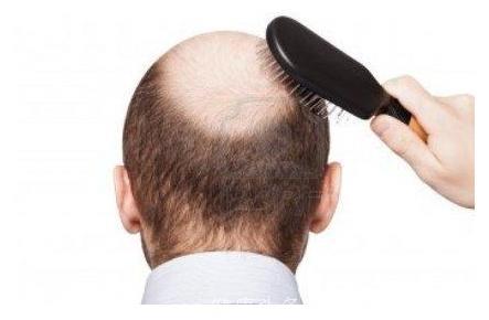 你还在困扰脱发问题吗？其实脱发是有好处的!脱发的人更长寿!
