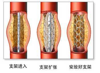 心脏病放完支架后患无穷？究竟支架有哪些副作用？我们都错了！