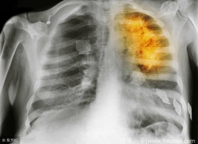 肺癌向我们敲响了警钟，专家剖析肺癌6大高危人群