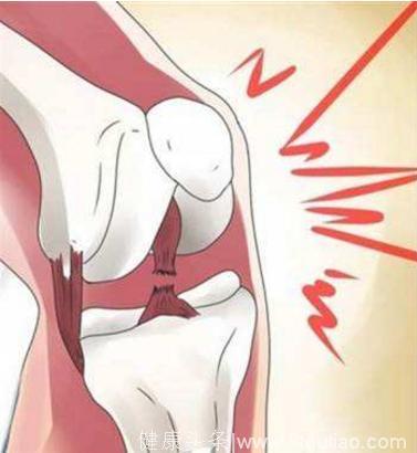 深蹲的时候膝关节咯吱咯吱的响，是不是膝关节炎？还能深蹲吗