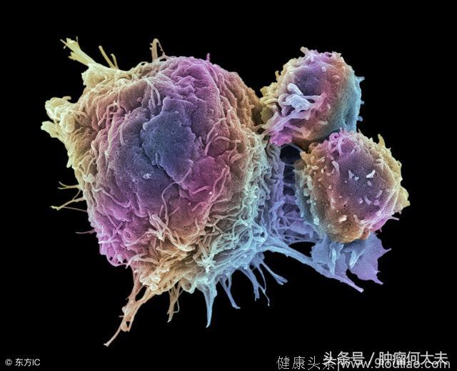 有一种肿瘤叫“癌肉瘤”：它比癌症更难治，比肉瘤更多见！