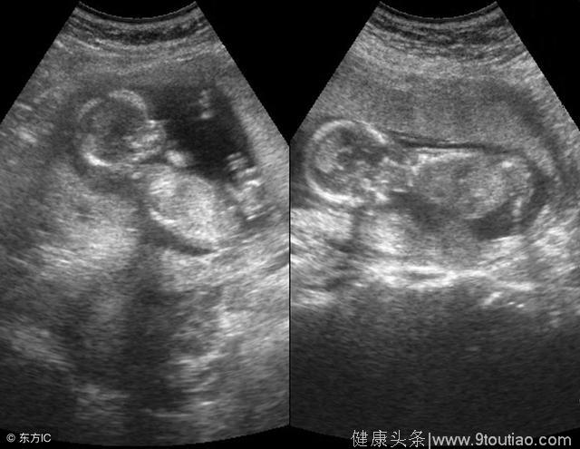 怀孕30周被劝引产腹中双胞胎，宝妈落泪，娘家人心疼！