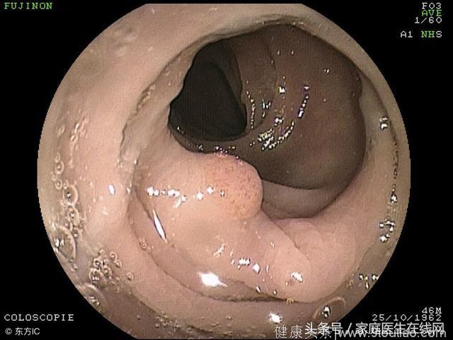 这种病很容易恶化成肠癌，早日发现还能扼制住它