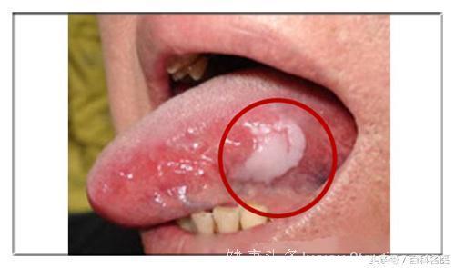 身体出现3种症状，提醒你可能患上口腔癌！