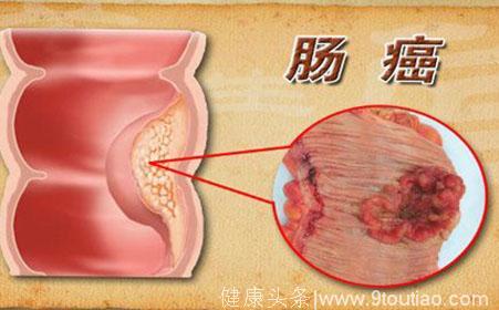 肠炎、肠癌、便秘惹人烦，请来“肠道清洁员”预防起来不算难